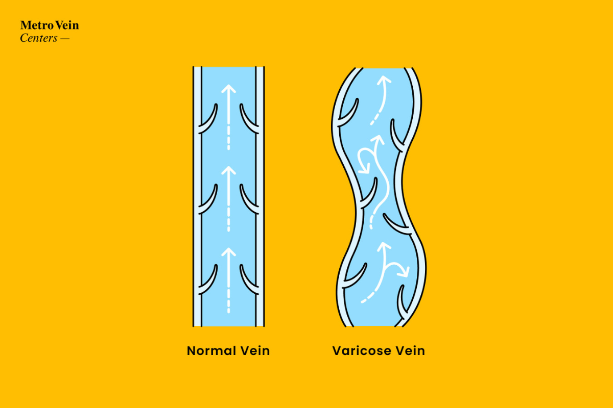 5 Simple Exercises for Relief of Varicose Vein Pain: Center for