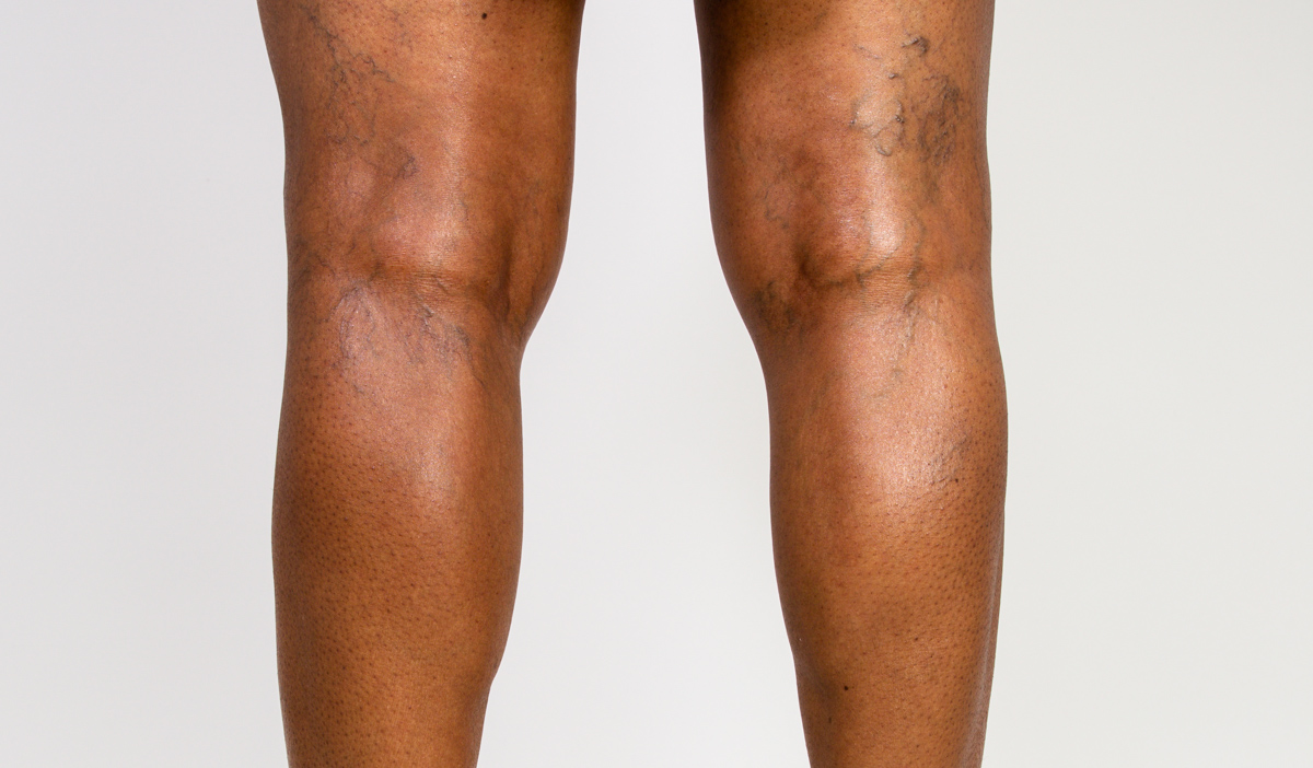 Varicose vein black hi-res stock photography and images - Page 2