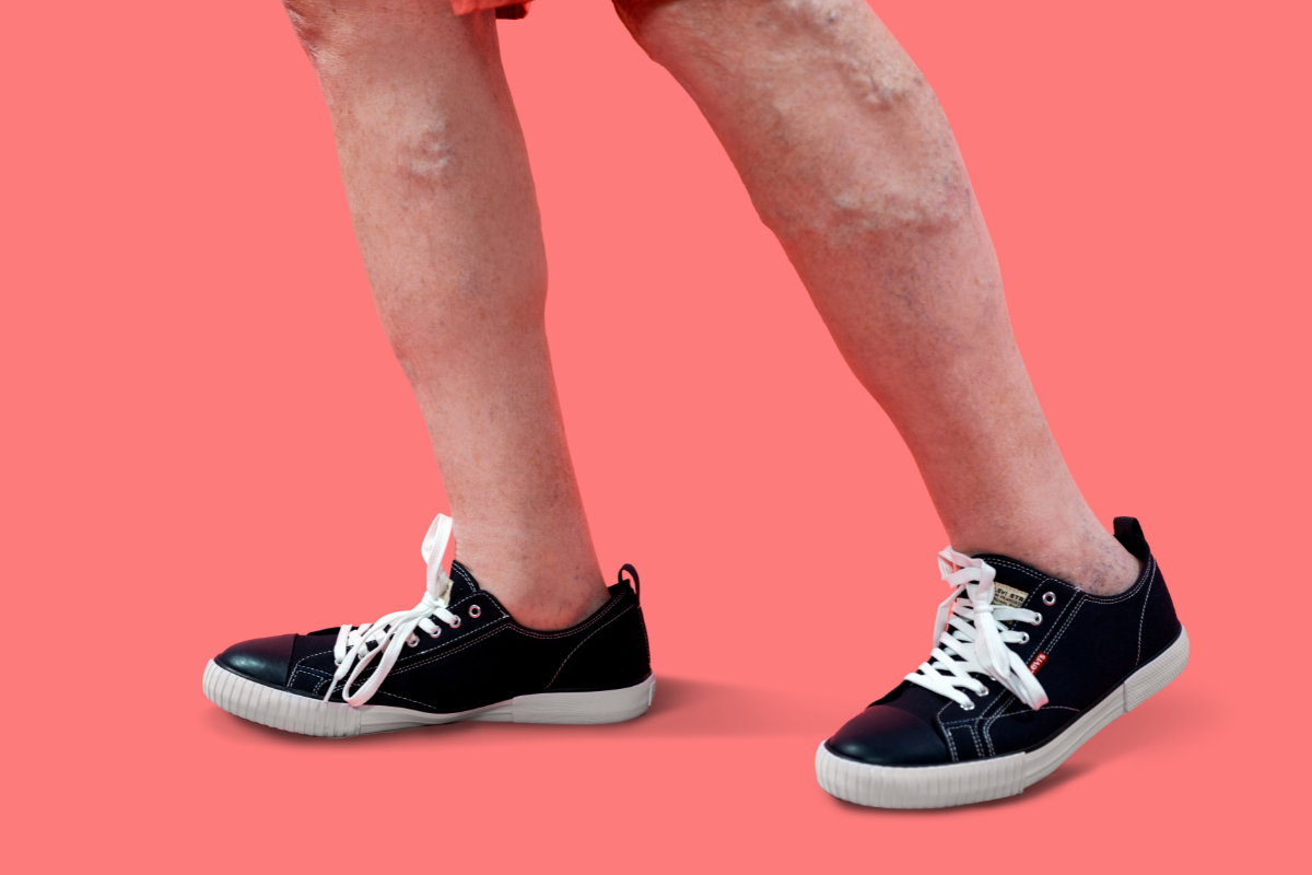 Varicose Veins Cause Restless Legs