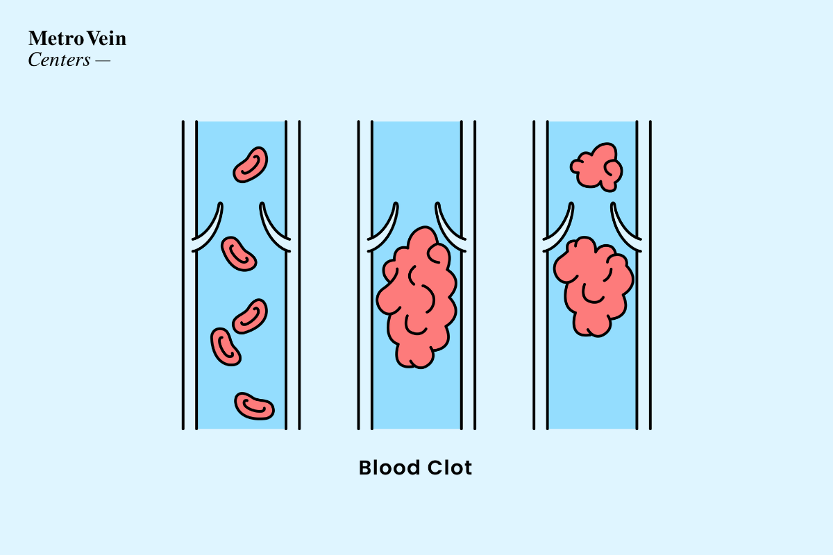 Blood Clot: Symptoms, Treatment, Prevention, and More