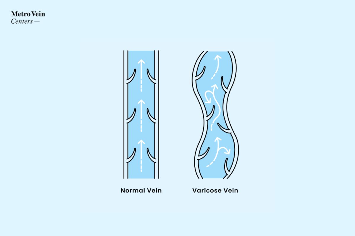 Vascular Access Centre - How to prevent varicose veins from
