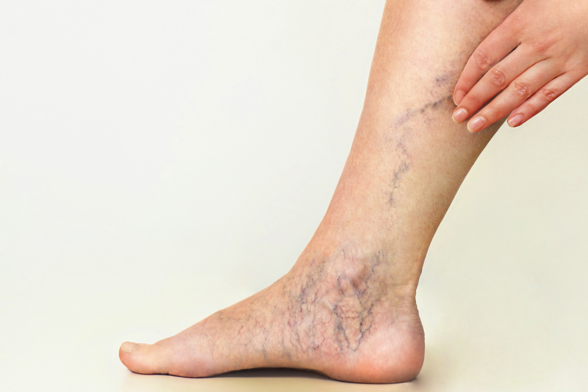 Spider Vein Symptoms You May Not Expect