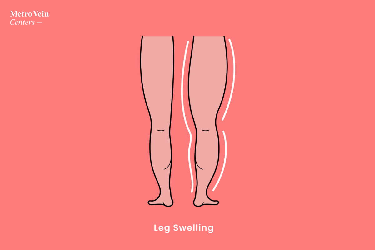 how-varicose-veins-can-cause-swollen-legs-metro-vein-centers