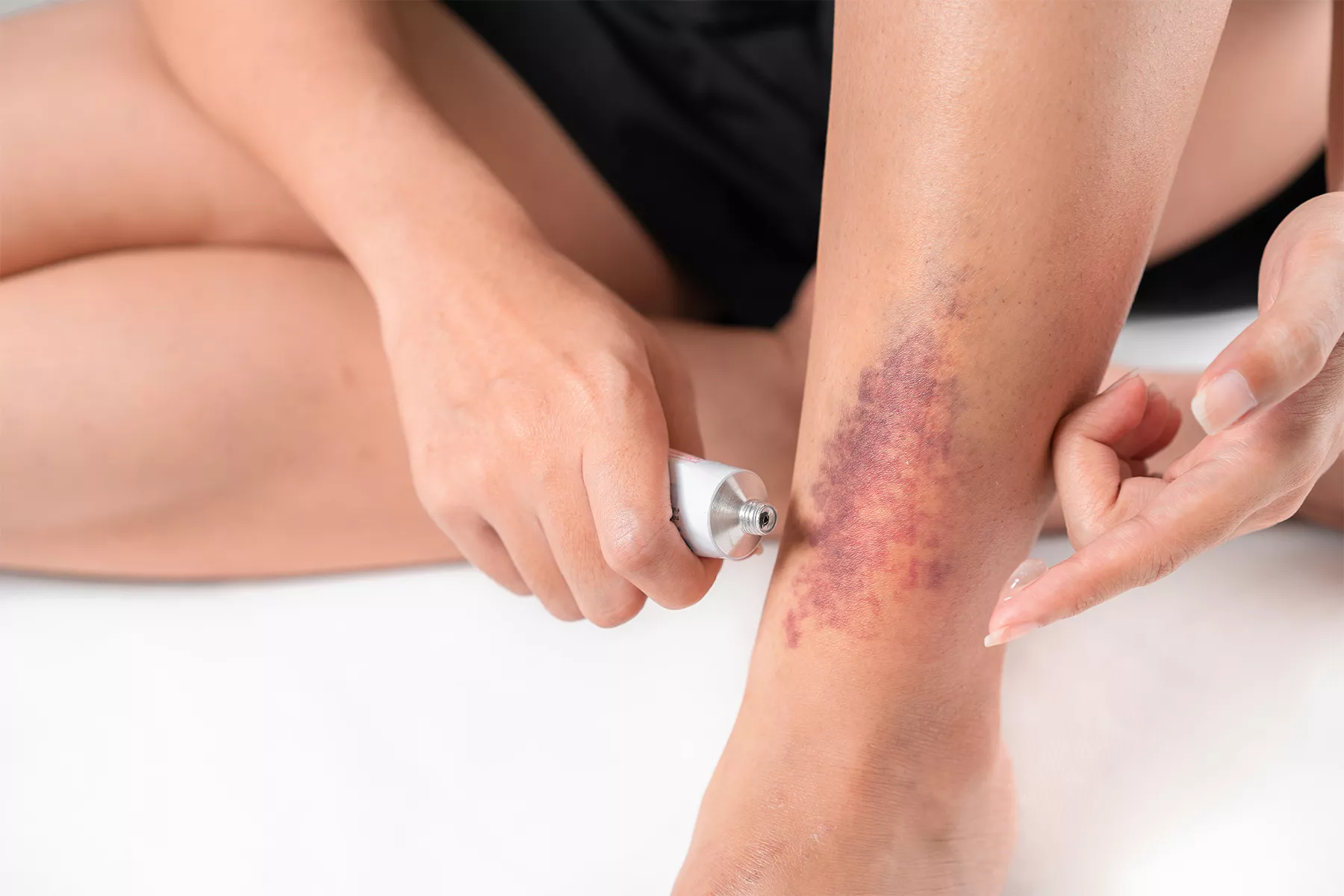 Learn how to manage common side effects of vein treatments effectively. Discover expert tips for a smooth recovery and optimal results from your vein procedure.