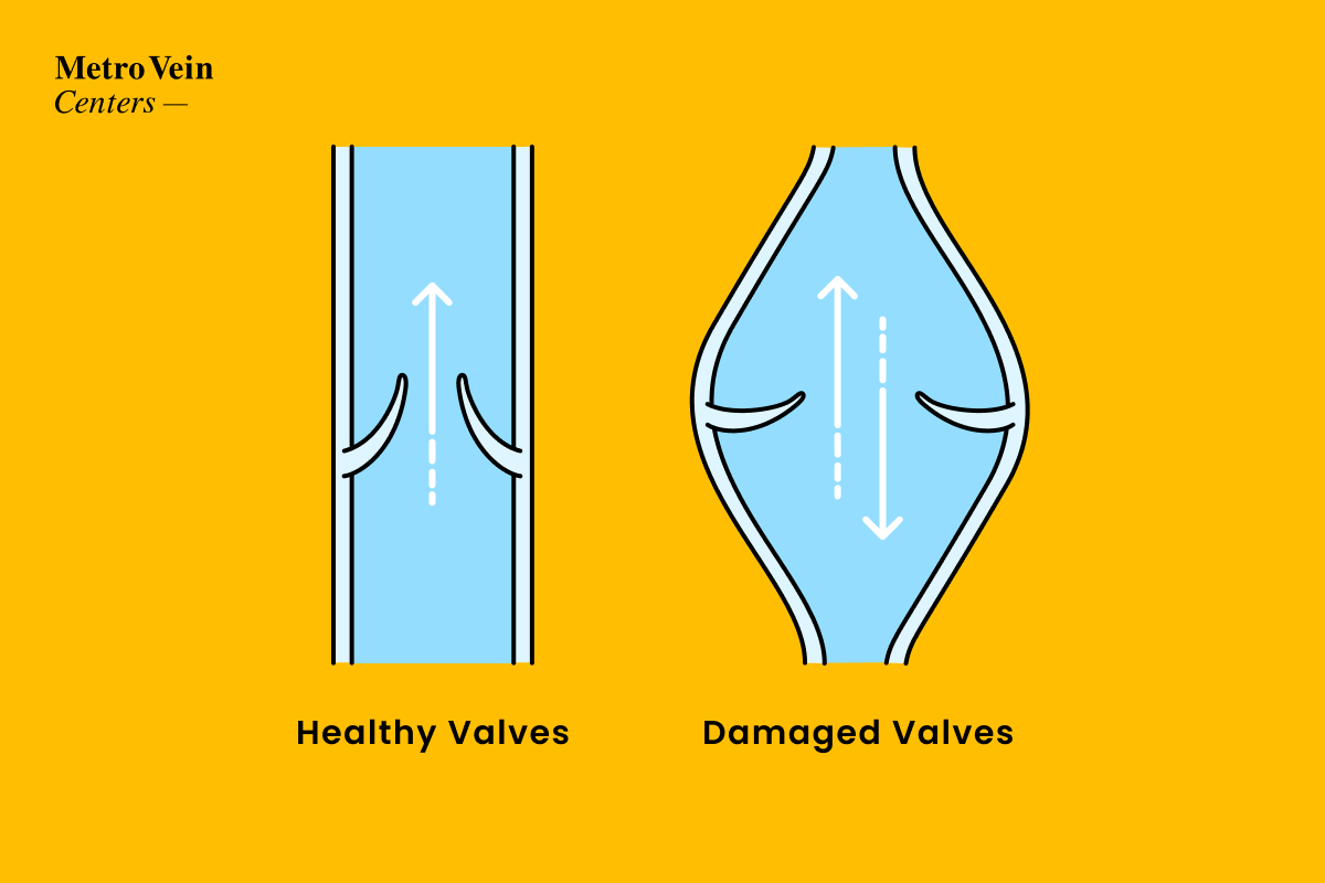 pregnancy-and-varicose-veins-metro-vein-centers