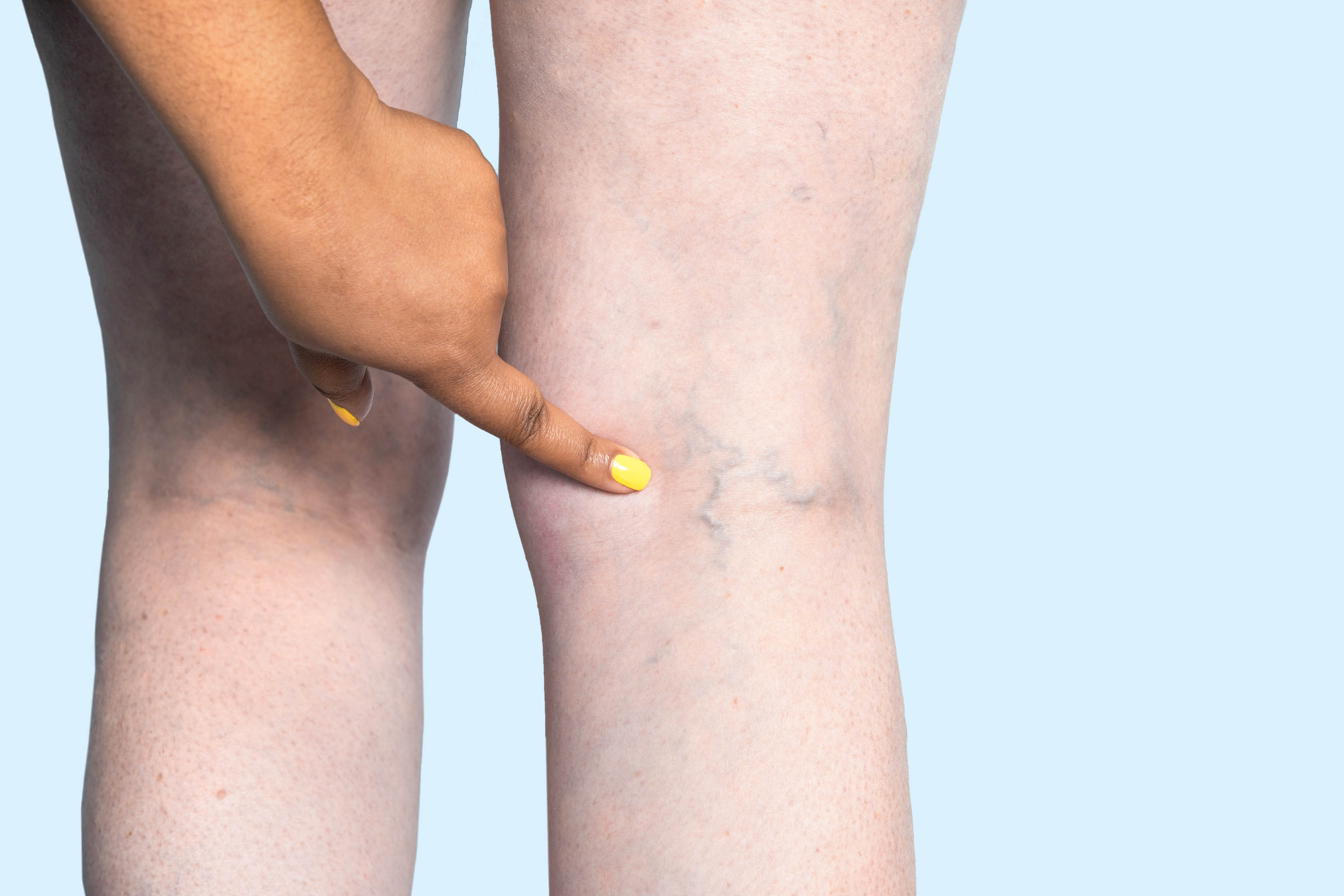 How Compression Stockings Can Help with Varicose Veins - St Johns Vein  Center