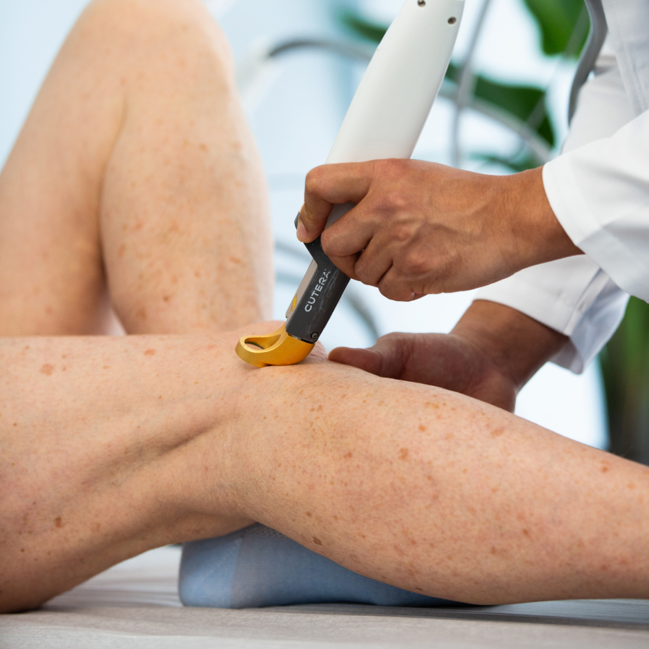 Spider Veins 101  Learn About the Symptoms of Vein Disease